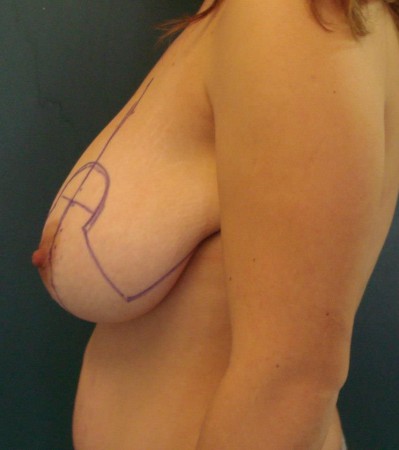 1. eset. Jelentős megnagyobbodás és süllyedés miatt 40% kisebbítést terveztünk.