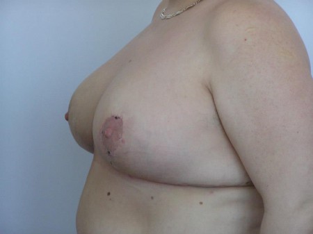  2. eset, műtét után 3 héttel.