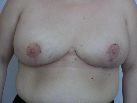  2. eset, műtét után 3 héttel.