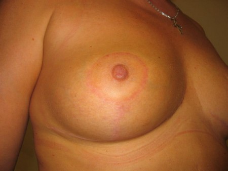  Felvarrást követő, fordított T alakú műtét utáni heg. 6. posztoperatív hónap.