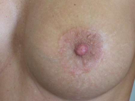  Bimbó körüli behatolás szépen gyógyult hege. 6. posztoperatív hónap