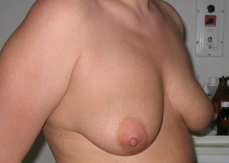 Add meg a leírástSpeciális emlőalak, nagyobbítás és felvarrás előtti kép.