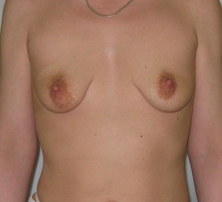 Nagyobbítás + felvarrás előtt