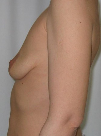 Nagyobbítás + felvarrás előtt