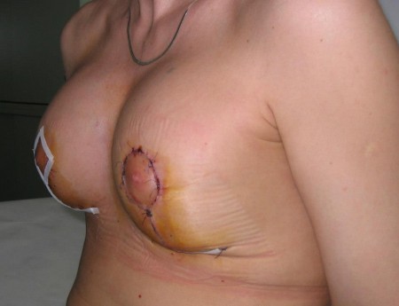 Nagyobbítás + felvarrás után. 7. posztoperatív nap. Szükségszerű duzzanat, bevérzések.