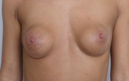 IV. stádiumú tokosodás, műtét előtt