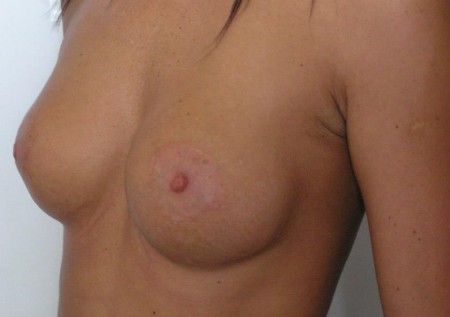 IV. stádiumú tokosodás, tokfelszabadítás utáni állapot